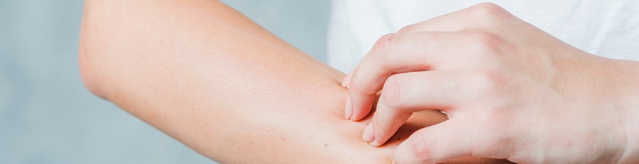 Žihľavka – častý kožný problém nielen u detí